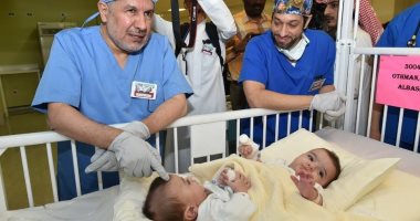صور.. بدء عملية فصل توأم سيامى ليبى فى الرياض