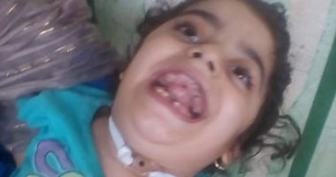 صور.. مأساة طفلة بالشرقية أصيبت بشلل بسبب إهمال طبى.. والدتها تتمنى علاجها