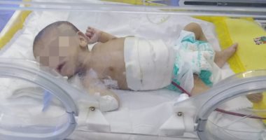 صور.. فريق طبى ينجح فى إجراء جراحة لإنقاذ حياة رضيع بالشرقية