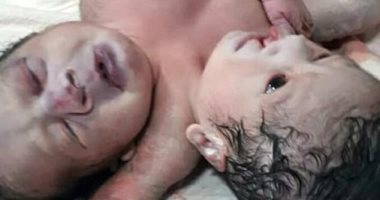 صور.. ولادة نادرة لتوأمين ملتصقين فى الهند برأسين و3 أذرع