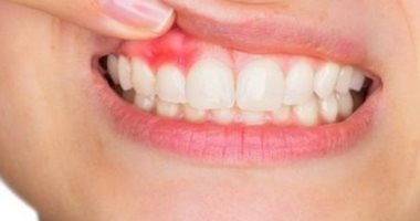س وج.. كل ما تريد معرفته عن خراج الأسنان