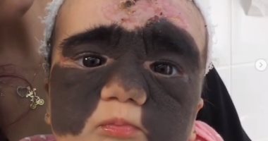طفلة "وحمة باتمان" الأمريكية فى طريقها للعلاج.. ووالدتها تشكف تفاصيل الجراحة