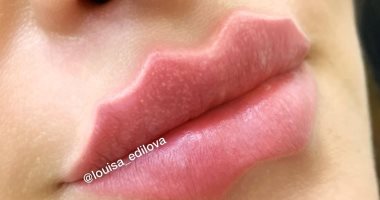 موضة مرعبة.. "شفاه الشيطان" أحدث تقاليع عمليات التجميل للسيدات