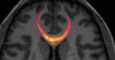 لماذا يواجه مرضى الارتجاج صعوبة فى القراءة؟