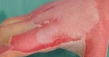 جرعة دواء خاطئة لطفل 11 عاما تفقده جلده وتعرضه للموت فى إسبانيا