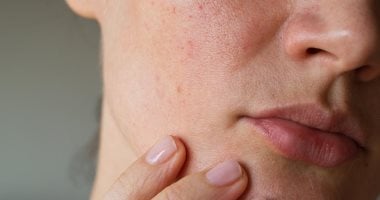 لو بتعانى من المسام الواسعة.. تعرفى على روتين العناية بالبشرة