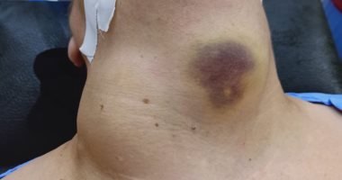 استئصال ورم يزن كيلو جرام من رقبة سيدة بإحدى مستشفيات كفر الشيخ