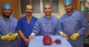 جامعة أسيوط تنجح فى إنقاذ حياة طفلة باستئصال ورم نادر يزن 10 كيلو بالبنكرياس