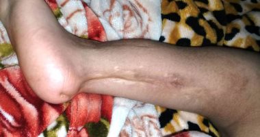 مأساة الطفل كمال من المحلة.. أجرى 9 عمليات بقدمه اليسرى ويحتاج لطرف صناعى