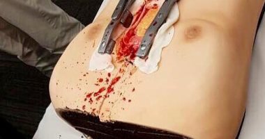 كعكة تشبه إنسان يجرى عملية قلب احتفالا بذكرى مئوية مستشفى في نيوزيلندا.. صور