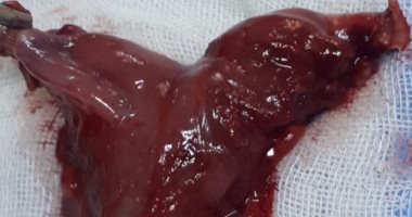 حالة طبية نادرة فى قنا.. فريق طبى ينجح فى استئصال رحم من رجل.. المريض طلب إجراء جراحة لإنزال الخصية.. والأطباء فوجئوا أثناء إجراء العملية بوجود نسيج مماثل لمبايض السيدات.. والأطباء: الشاب كان معرضا لأورام خبيثة