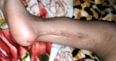 تضامن الغربية توفر جهازا تعويضيا لطفل أمر الأطباء ببتر قدمه
