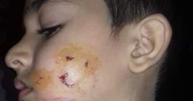 كلب يعقر طفل بكفر شكر بالقليوبية..والمحافظ يدفع بفرق طوارئ لمواجهه الكلاب الضالة