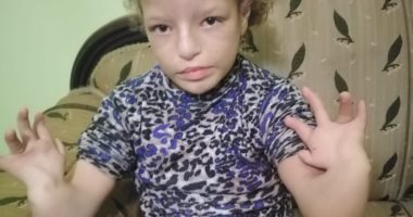 مأساة طفلة من ذوى الإعاقة بالغربية ووالدها يناشد بإجراء جراحة لها