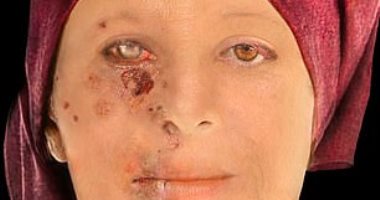 امرأة مصابة بالجذام.. دراسة تعيد وجوه أول سكان مدينة إدنبره للحياة