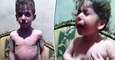 "سيبها علينا".. طفلان بالشرقية مصابان بمرض جلدى مزمن ويحتاجان للعلاج.. صور