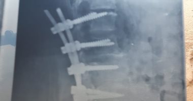 قارئة تناشد وزارة الصحة بإجراء عملية لوالدتها فى ظهرها لإزالة 12 مسمارا