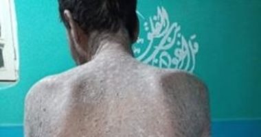 قارئ يستغيث بوزارة الصحة لتوفير دواء مستمر لمرض الصدفية.. صور