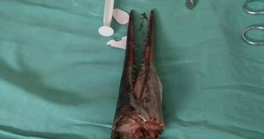 من الصيد ما قتل.. سمكة إبرة تخترق رقبة صبى فى إندونيسيا.. اعرف القصة