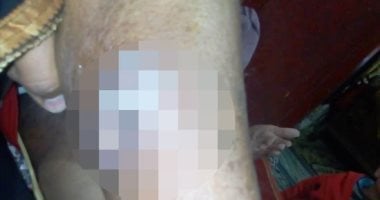 سيبها علينا".. قارئ يناشد الصحة لعلاج ولدته المصابة بالقدم السكرى 