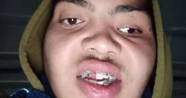   سيبها علينا .. والد طالب جامعى بالشرقية تعرض لكسور بالجمجمة والوجه يناشد بعلاجه