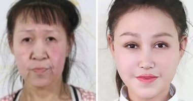 فتاة فى الـ 15 من عمرها تخضع لجراحة تجميل "علشان شكلها عجوزة"