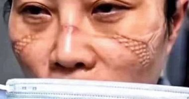 صور.. تقرحات الوجه ضريبة مكافحة فيروس كورونا للفريق الطبى بالصين 