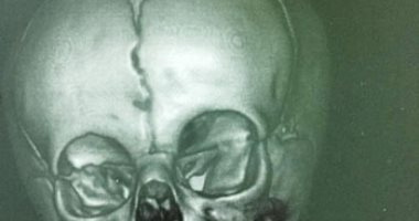 التأمين الصحى ينجح فى جراحة نادرة لإزالة التصاق عظمى بالفكين لرضيعة.. صور