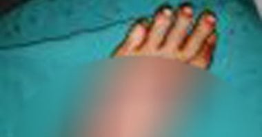نجاح جراحة تجميل معقدة لإعادة قدم إلى طبيعتها بمستشفى التأمين الصحى ببنى سويف