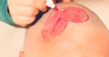 ابنة يوسف الخال ترسم قلب على رأسه. ويعلق: "قلب بنتى من إيدها مباشرة ع رأسى"