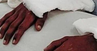بالصور..ذراع رجل يتغير لونها وحجمها بعد زراعتها لفتاة هندية تعرضت لحادث سير