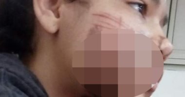 أكمنة لضبط المتهم بحرق ابنته بمادة كاوية فى الجيزة