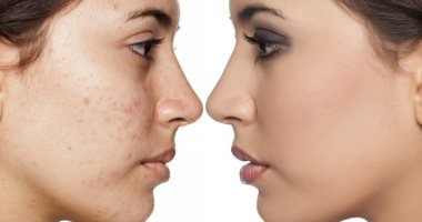 من البول لدواء الحموضة ومنظف الزجاج.. أغرب طرق العناية بالبشرة وعلاج حب الشباب