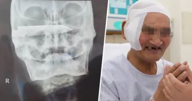 أطباء صينيون ينجحون فى إزالة نصل سكين من رأس كهل صينى عاش به 26 سنة