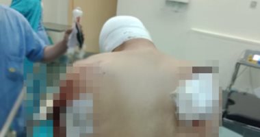 استخراج سيخ حديد اخترق الرئة اليسرى لمواطن بمستشفى الطوارئ بجامعة المنصورة