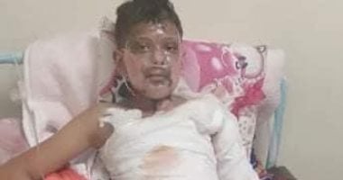 وزيرة الصحة تستجيب لـ"اليوم السابع" وتنقل طفل الإسماعيلية لعناية ههيا للحروق