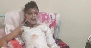 مواطن يناشد وزارة الصحة توفير عناية حروق لنجله بعد انفجار تنك بنزين بجواره