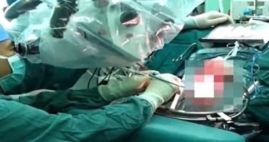 نشنت يا فالح.. صيني ينجو بإعجوبة بعد إصابته لنفسه بمسدس المسامير في الرأس 