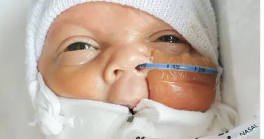 ديلى ميل: ولادة طفل بحجم "الريموت" فى حالة نادرة بعد خضوعه لجراحتين