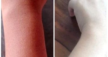 بيخليهم "زومبى" ..كريم تفتيح بشرة فى تايلاند يحول لون البشرة إلى "الأبيض"