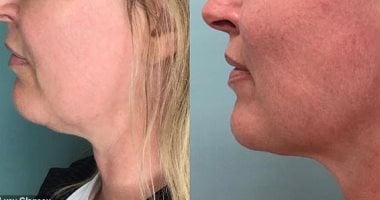 مكالمات "زووم" تتسبب فى زيادة الطلب على عمليات التجميل.. اعرف الحكاية
