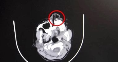 سبب لها صعوبة بالتنفس.. أطباء يزيلون "سن" من أنف طفلة استمر 4 سنوات.. صور
