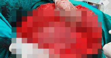 استئصال جزء منحشر داخل أمعاء سيدة يزن 12 كيلو فى مستشفى بطنطا