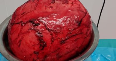 فريق جراحى بجامعة المنصورة ينجح فى استئصال ورم بوزن 7 كيلوجرام