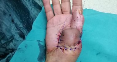 صور.. جراحة تجميلية لإنقاذ يد مريض يعانى من كسر متفتت بإصبع الإبهام الأيمن بأرمنت