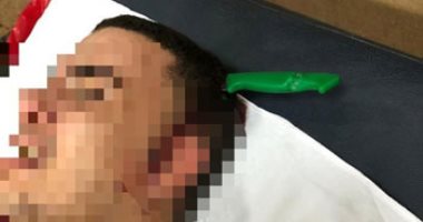 أطباء قصر العينى ينقذون شابا ويستخرجون سكينا نافذا إلى المخ من رأسه.. صور