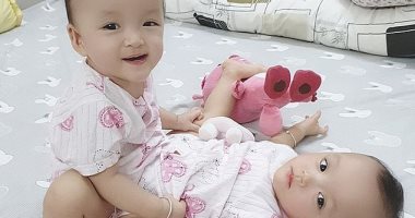 صور.. 100 طبيب يفصلون توأما ملتصقا فى عملية شاقة استغرقت 12 ساعة