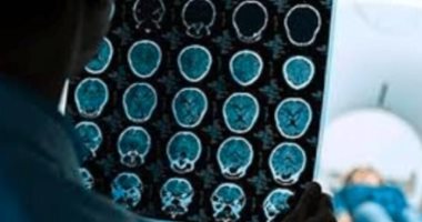 جلطة دماغية تمنح إيطاليا لكنة أجنبية جديدة فى حالة نادرة.. اعرف التفاصيل
