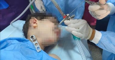فريق جراحى بمستشفى بنها الجامعى ينجح باستخراج سوكت شاحن من القصبة الهوائية لطفل