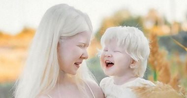  شقيقتان تعانيان من البَرص تتألقان كعارضات أزياء.. الجمال لا يعرف المرض